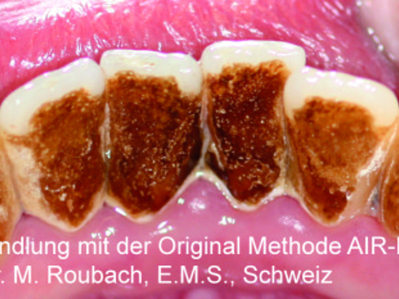 VOR AIR-FLOW Behandlung 75x35mm